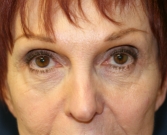 Feel Beautiful - Injectable Filler in Lower Eyelids - Before Photo